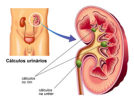 Definição cálculos urinários