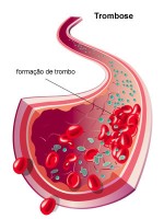 Trombose