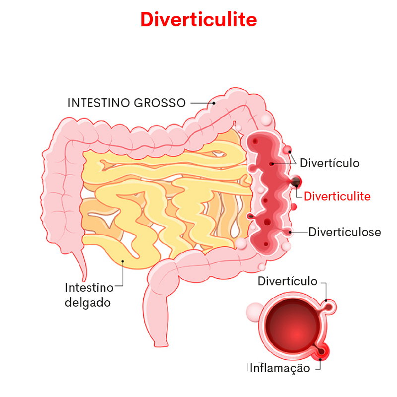 Diverticulite